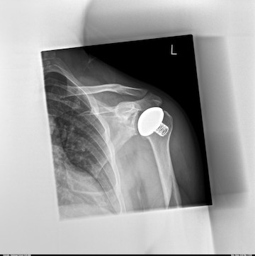 shoulder endoprosthesis in Germany