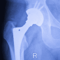  hip arthoplasty in Germany