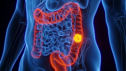 Colon cancer treatment in Germany
