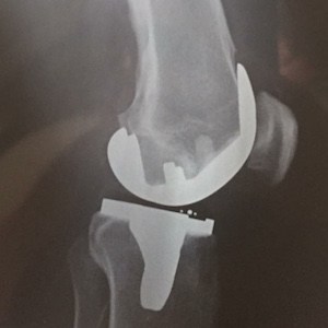 knee replacement surgery in German
