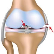 Knee Ligament ACL - affordable treatment in Germany
