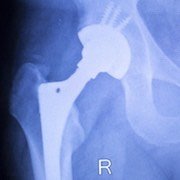 affordable-hip-surgery in germany
