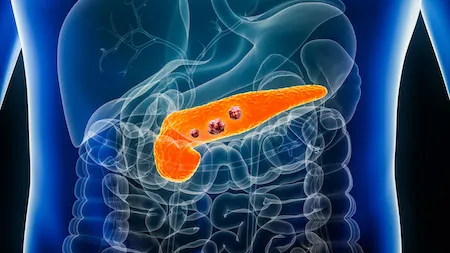 dendritic cell vaccination for pancreas cancer