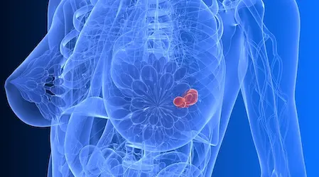 Dendritic cell therapy for breast cancer in Germany