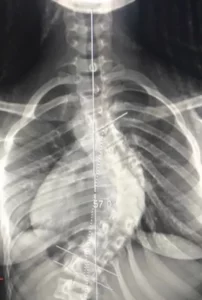 best scoliosis surgery in Germany - GermanyHealth